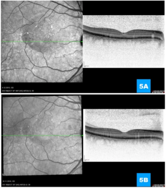 (A) Regression of activity of pathology with progressive normalisation of retinal layers 1 month and (B) 1 year
after performance of photodynamic therapy respectively 