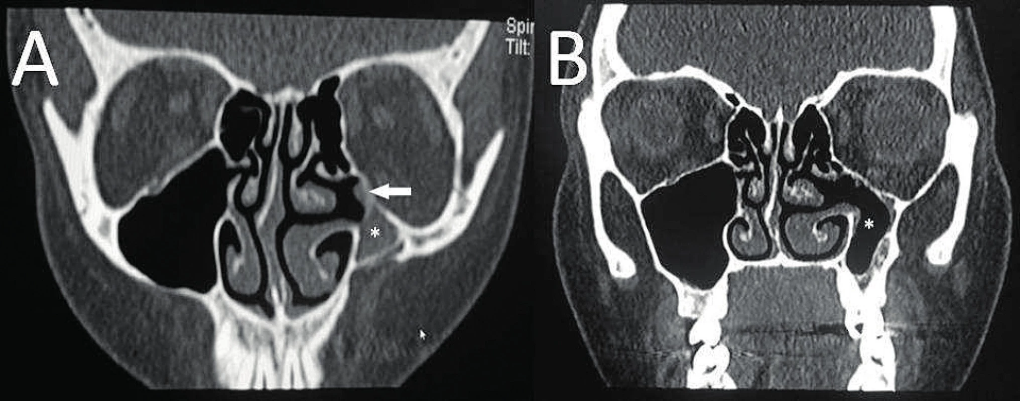 CT VND, koronární projekce; A) před výkonem, retrakce procesus uncinatus a jeho přiložení ke spodině orbity (viz šipka); B)
3 měsíce po operaci; (*) levá čelistní dutina.