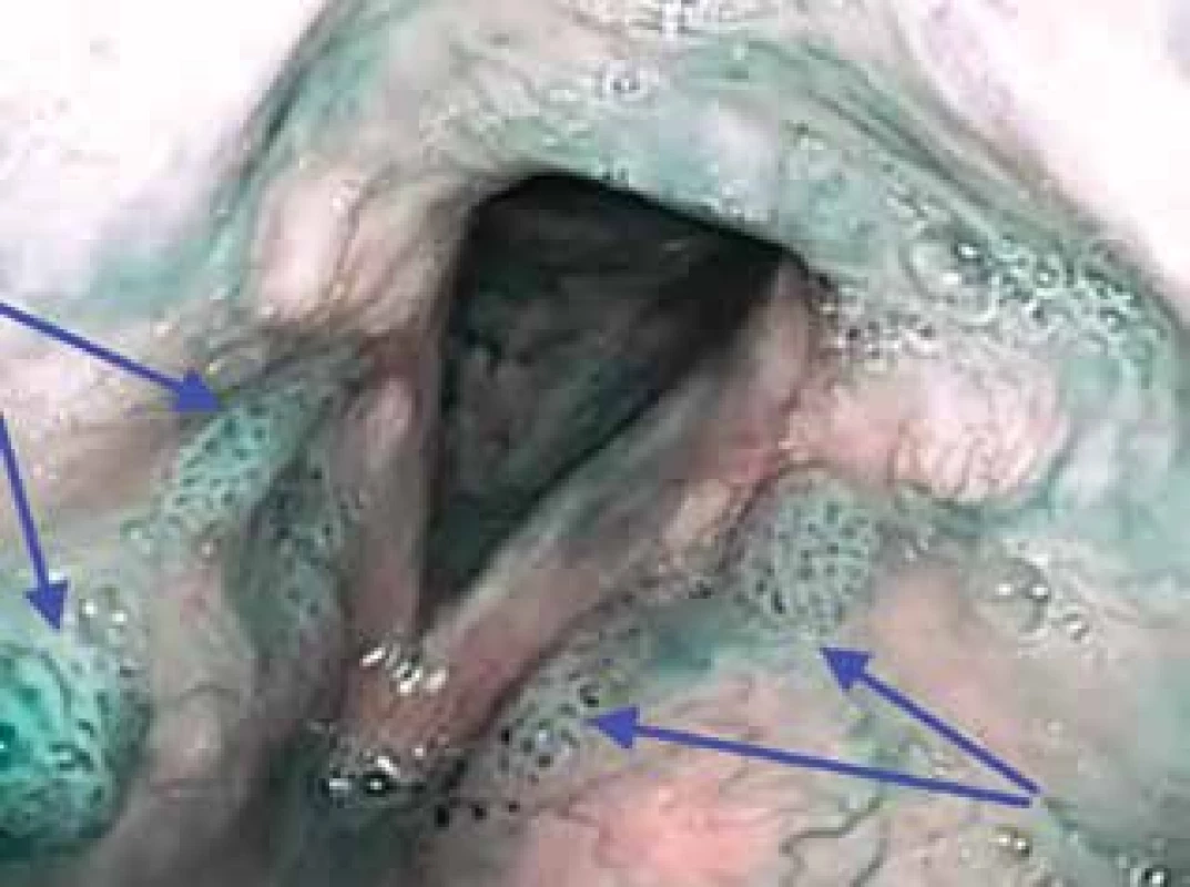 Vícečetné léze papilomů v oblasti obou vestibulárních řas hrtanu v NBI (IPCL IV. typu dle Ni, značeno modrými šipkami)