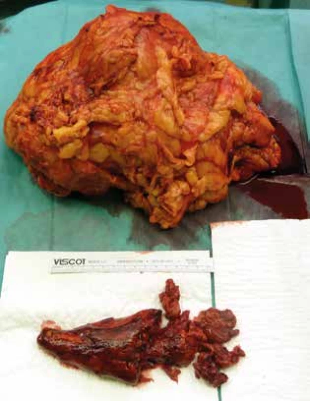 Oblička a nádorový trombus z dolnej dutej žily <br>Fig. 4: The kidney and the tumour thrombus of the inferior vena cava
