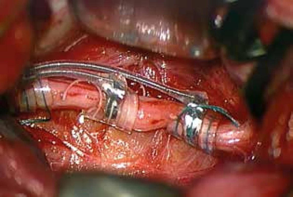 Elektroda na vagovém nervu<br>
Fig. 3: Electrode around the vagus nerve