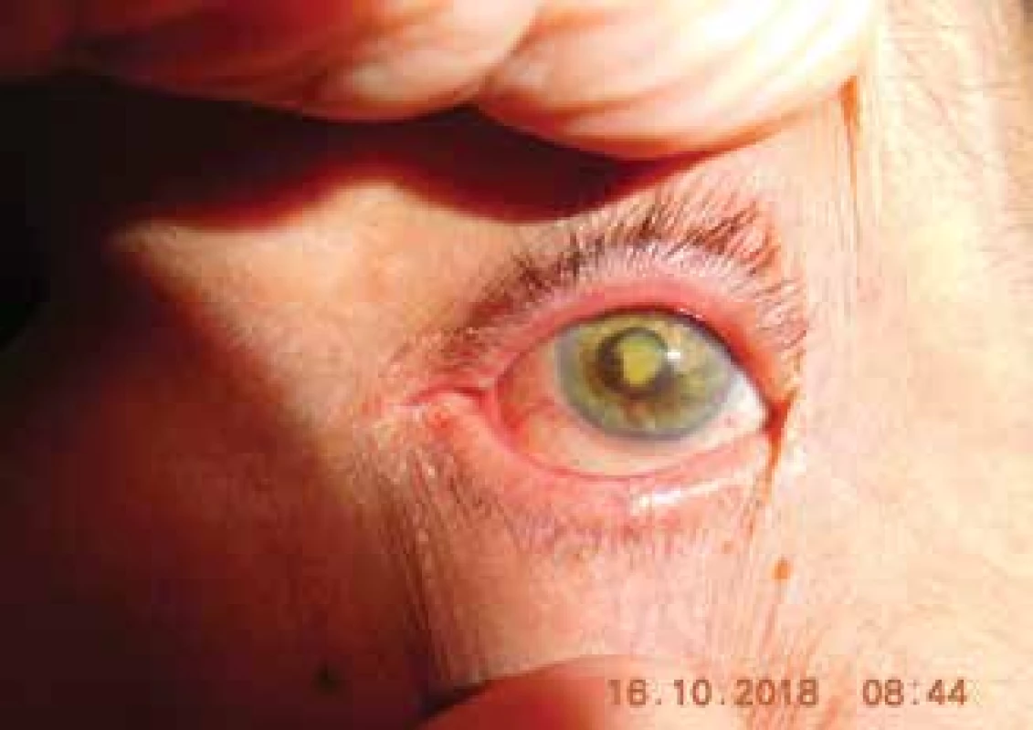 Patient with post-radiation cataract and neovascular glaucoma