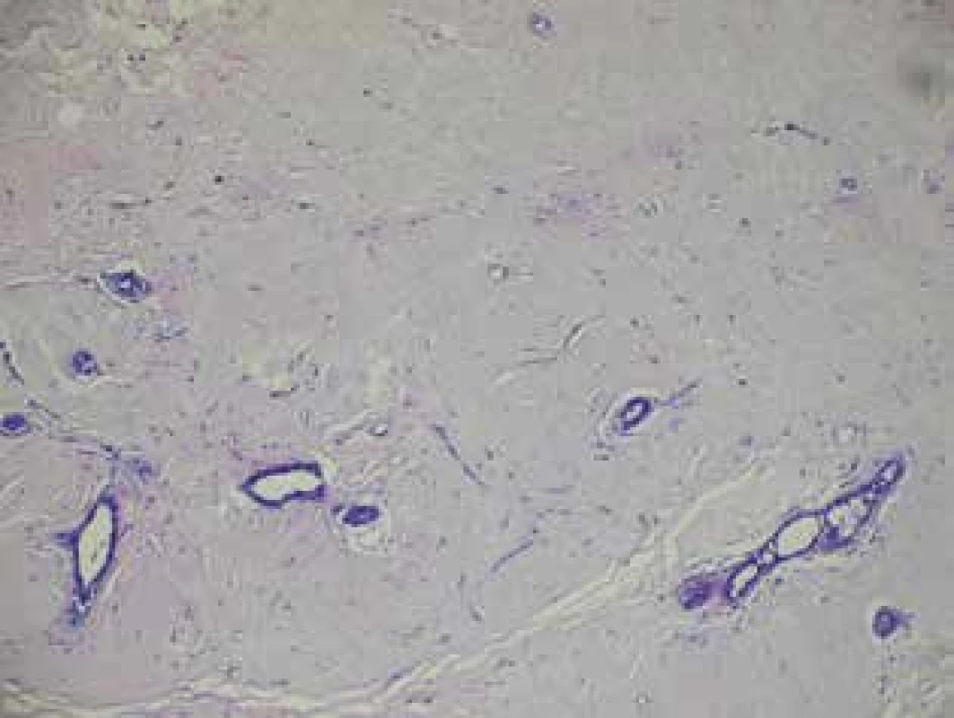 Projizvené nádorové lůžko bez maligních buněk po NT <br>Fig. 5: Scarred tumor bed without any malignant cells after NT