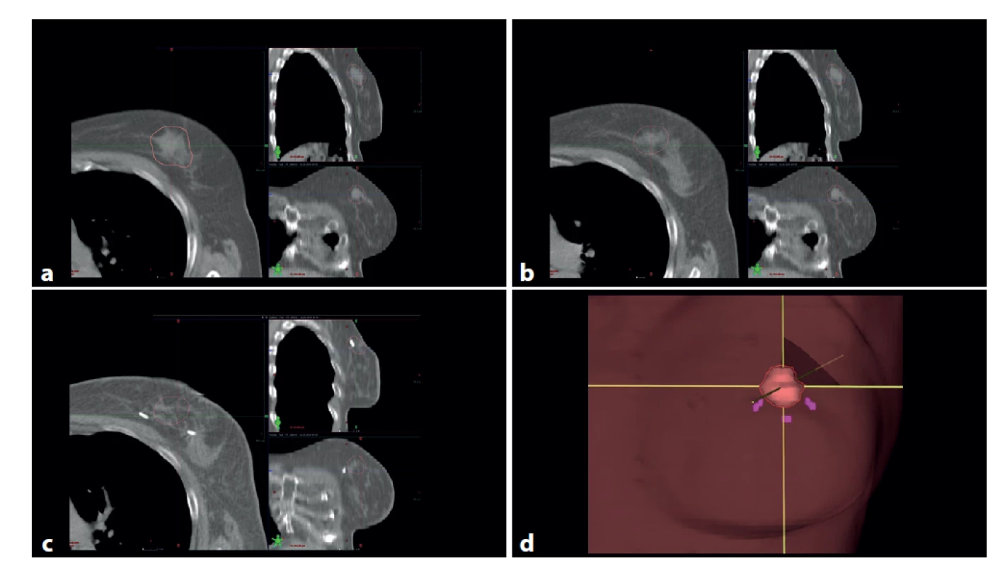 : a, b – předoperační CT s tumorem (konturován hnědě), c – pooperační CT s metalickými klipy v lůžku tumoru
(hnědě kontura původní lokalizace tumoru), d – 3D rekonstrukce oblasti původního tumoru (hnědá) a místa zavedených
metalických klipů (fialová)<br>
Fig. 1: a, b – preoperative CT, tumor contoured brown; c – postoperative CT with metallic markers in the postlumpectomy
cavity (original tumor site contoured brown); d – 3D reconstruction of the original tumor site (brown) and
the locations of metallic markers (purple)