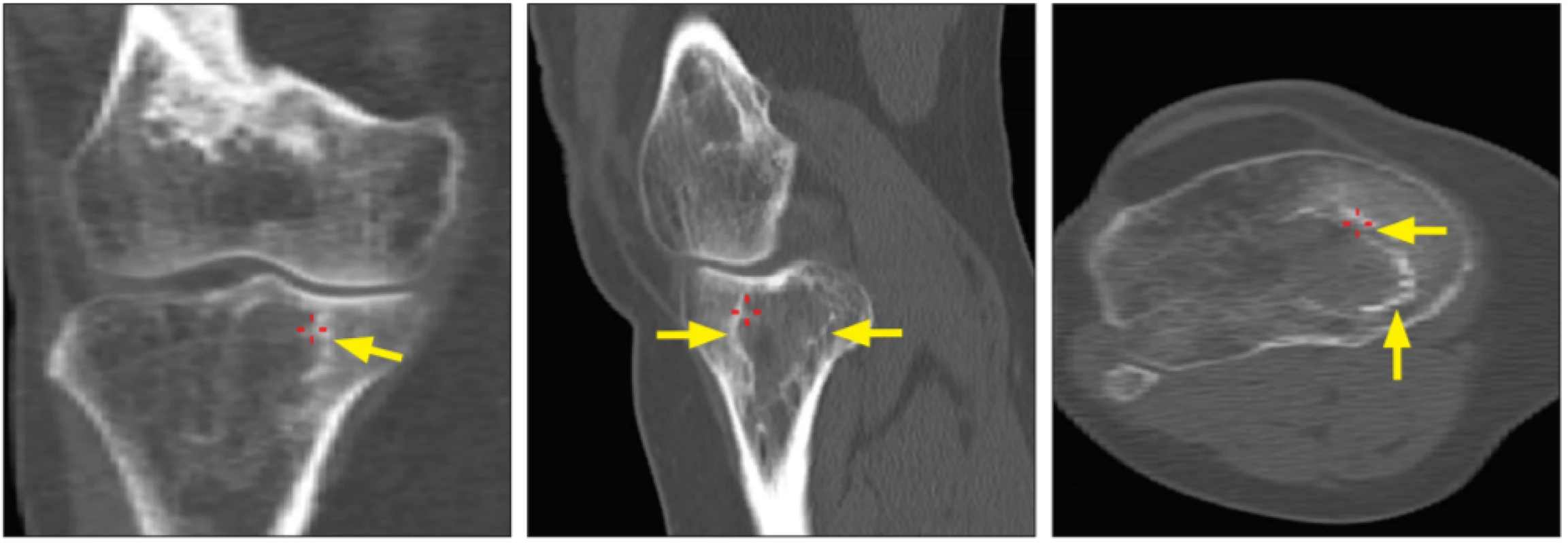 Plnohodnotné CT kolen (rekonstrukce á 2 mm), zobrazeno levé koleno. Šipkami označen nepravidelný sklerotický lem kolem dřeňové
dutiny v oblasti proximální tibie (vlevo řez ve frontální rovině, uprostřed řez v sagitální a vpravo v transverzální rovině).