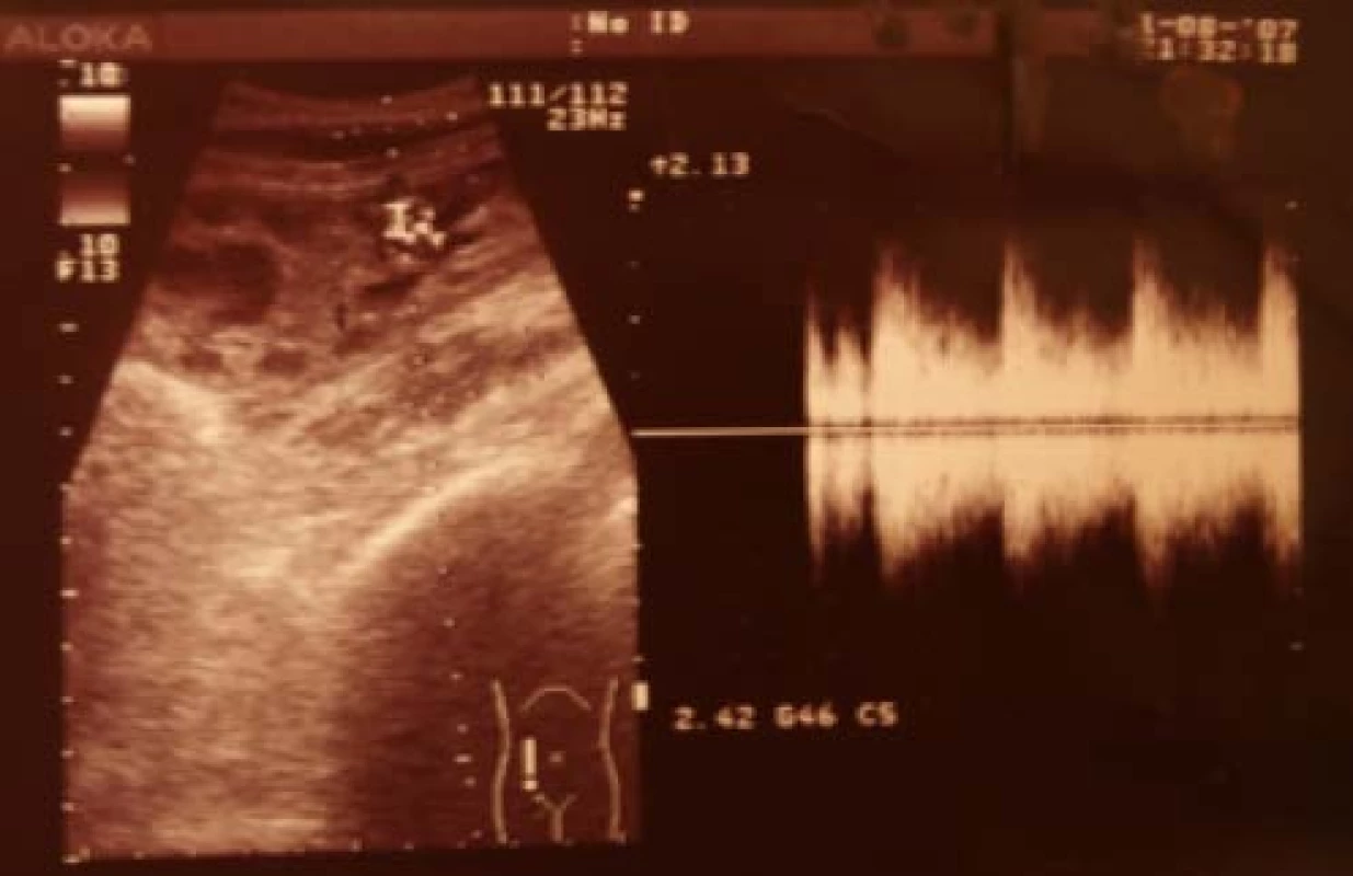 Artério-venózna
fistula po biopsii
transplantovanej obličky<br>
Fig. 1. Arterio-venous
fistula after biopsy of the
transplanted kidney