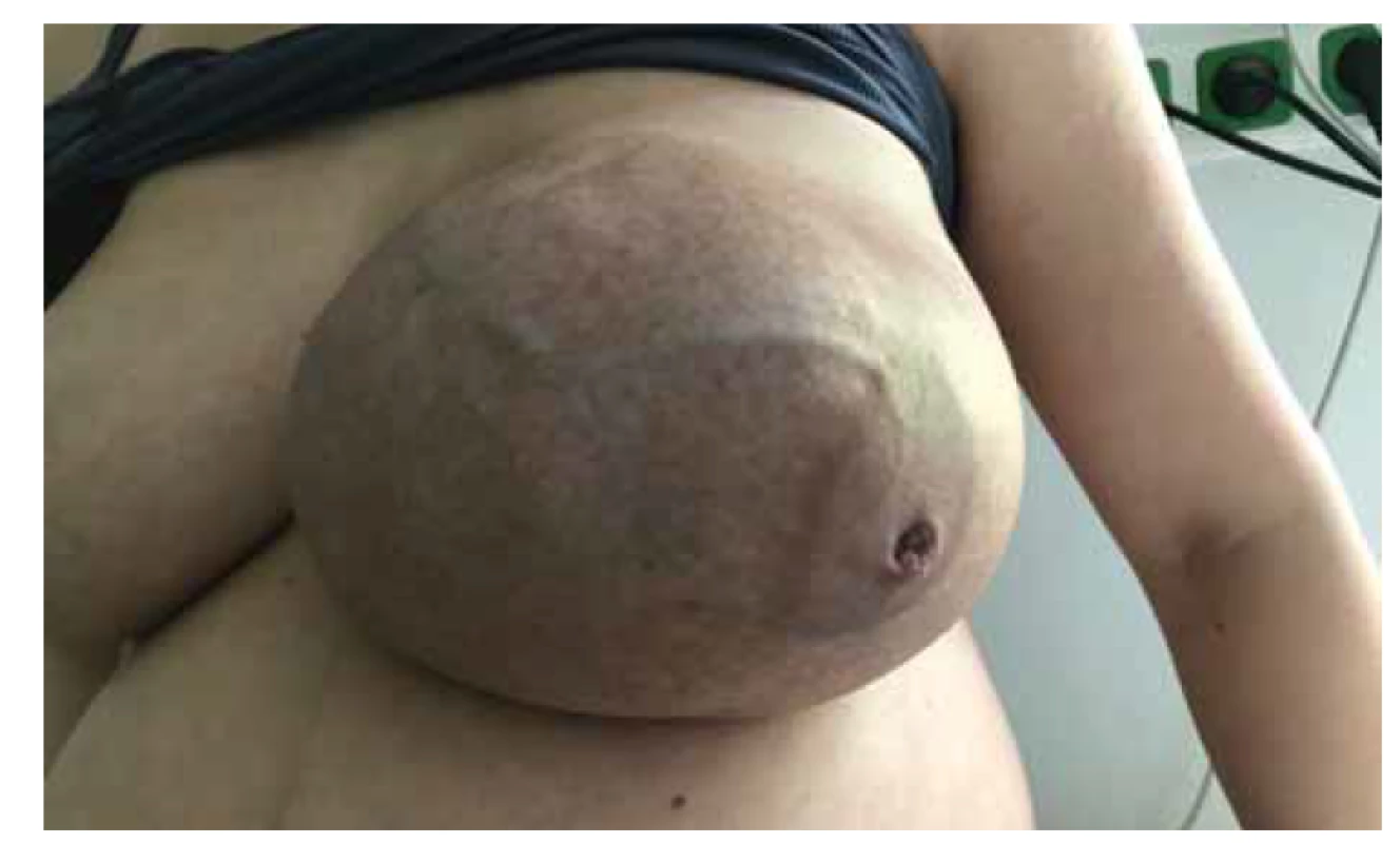 Obrovský fibroadenom prsu ve 35. týdnu těhotenství – venostáza,
vpáčená bradavka.<br>
Fig. 2. Giant breast fibroadenoma in 35th week of pregnancy – venostasis, nipple
inversion.