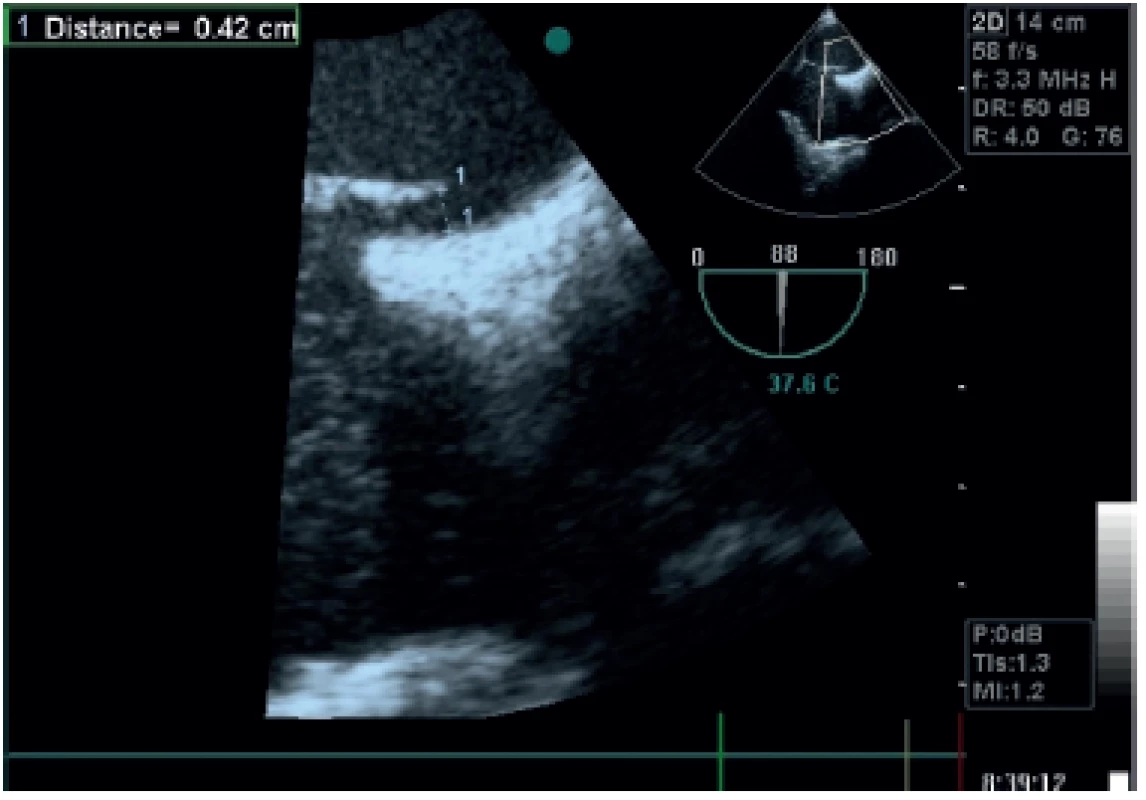 Contrast transesophageal echocardiography with agitated dextrose showing patent foramen ovale, length of the channel 22 mm, width of the channel 4.2 mm following Valsalva maneuver. Courtesy of Juraj Dubrava, MD, PhD., FESC, Head of the Department of Non-Invasive Cardiology, University Hospital Bratislava, St. Cyril and Method Hospital