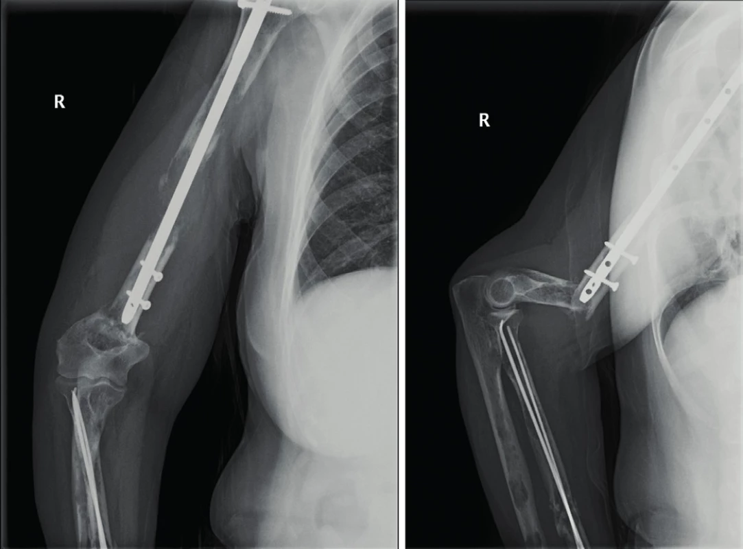 Woman, 62 years old, x-ray of the right humerus where a periimplant fracture is obvious, localised below the distal end of the nail. The original fracture in the osteolytic deposit is locked by an intramedullary nail