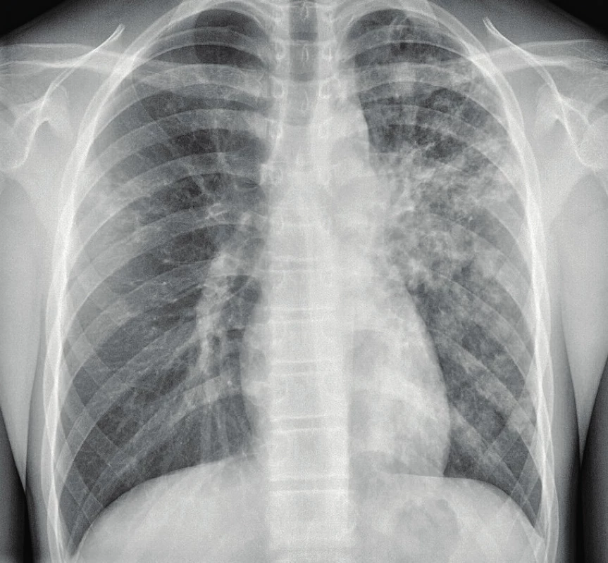 SKG hrudníku 16letého chlapce s hemoptýzou.
Mikroskopicky a kultivačně pozitivní tuberkulóza
vlevo, forma TB pneumonie, forma bronchopneumonická.<br>
Fig. 4. Chest X-ray of 16 years old boy with hemoptysis.