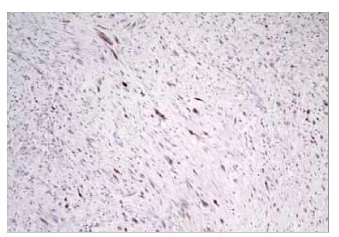 Cytoplazmatická exprese ALK (anaplastic lymphoma
kinase) v buňkách tumoru. Imunohistochemické
vyšetření, zvětšení 200x.<br>
Fig. 5. Cytoplasmic expression of ALK (anaplastic lymphoma
kinase) in tumor cells. Immunohistochemical examination,
magnification 200x.