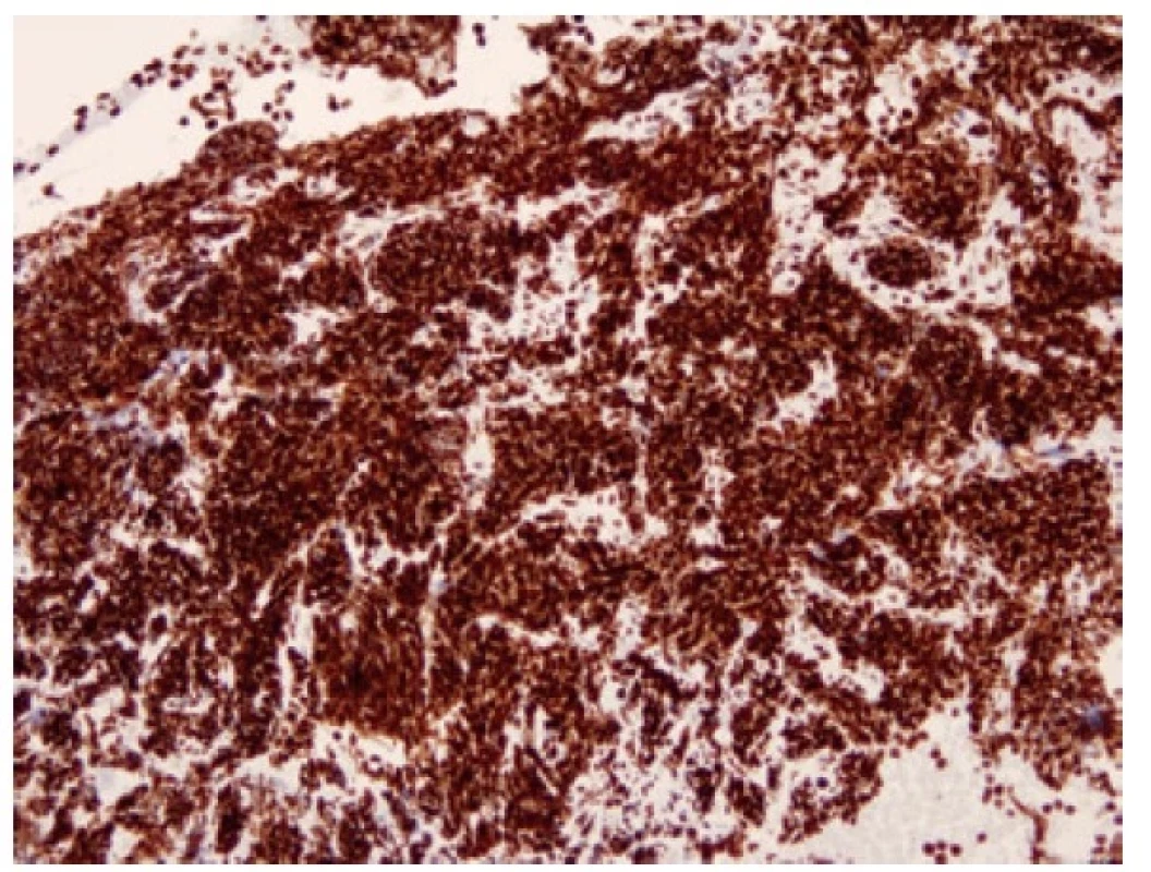 Malobuněčný karcinom pozitivní v imunohistochemickém průkazu
NEUROD1. 100x