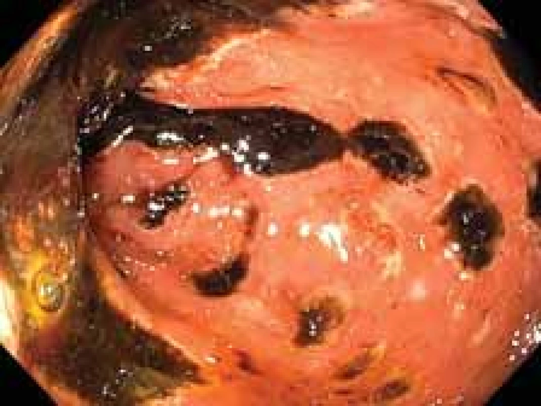 Mnohočetné cirkulární 
ulcerace duodena s hematinem na 
spodině.
Fig. 1. Multiple circular duodenal 
ulcerations covered with hematin.