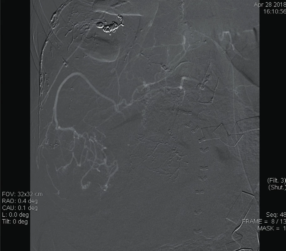 Digitální subtrakční angiografie a. lumbalis dextra:
zobrazuje se patologická vaskularizace angiolipomu [6]