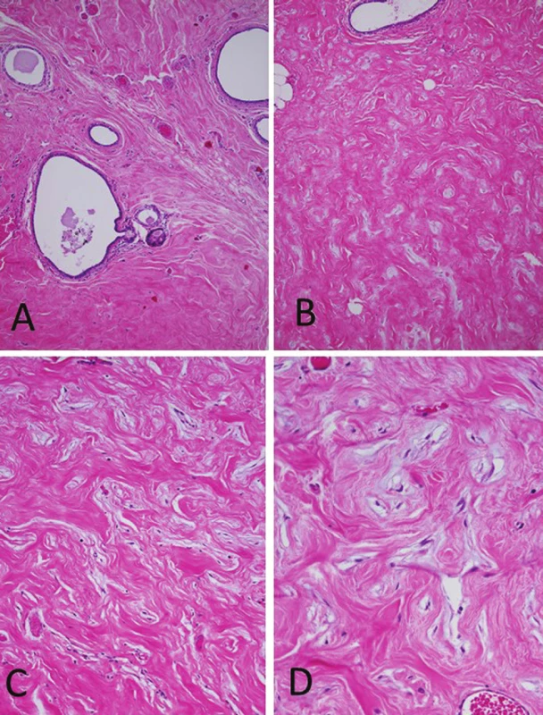 Histopathology of the axillary breast tissue. (A) Aberrant axillary breast
tissue including ectatic mammary ducts, absence of acinar tissue and increase
of the fibrous tissue (H&E, original magnification x100). (B) Interlobular stroma
showing elongated slit-like spaces lined by flattened spindle cells (H&E, original
magnification x100). (C) The spaces are empty, devoid of red blood cells (H&E,
original magnification x200). (D) Keloid-like fibrosis containing slit-like spaces
that simulate vascular channels. No cytologic atypia or mitotic activity was seen
in the spindle cells (H&E, original magnification x400).