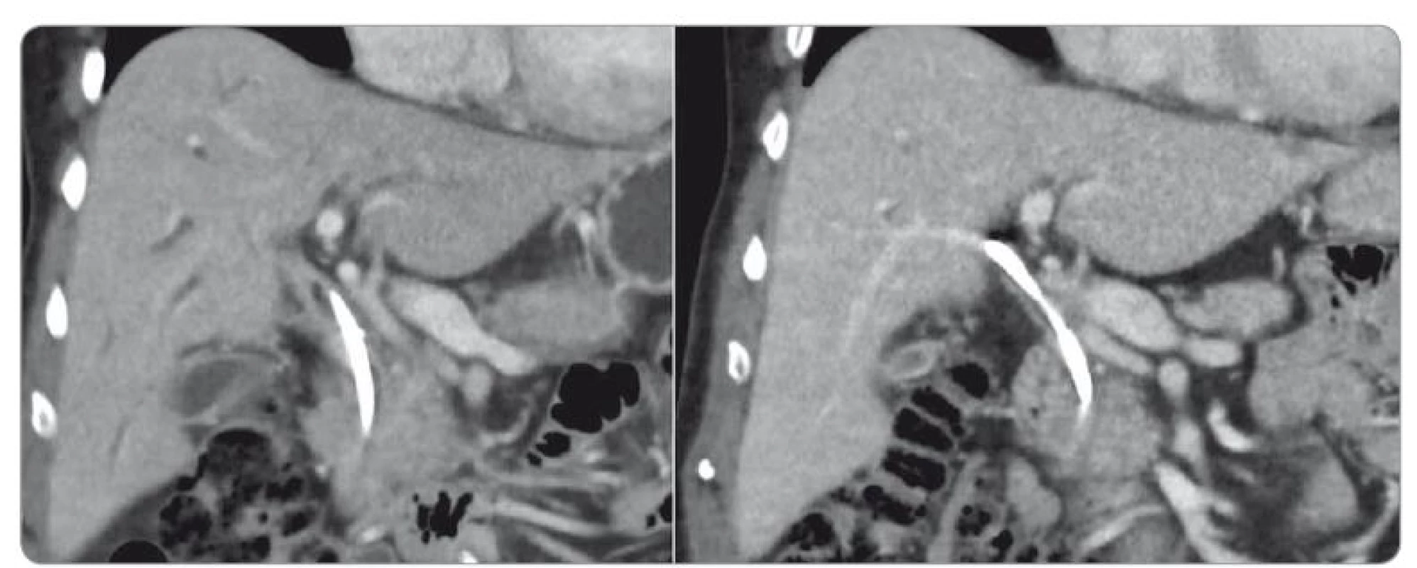 CT břicha před a po léčbě kortikosteroidy, koronární řezy.