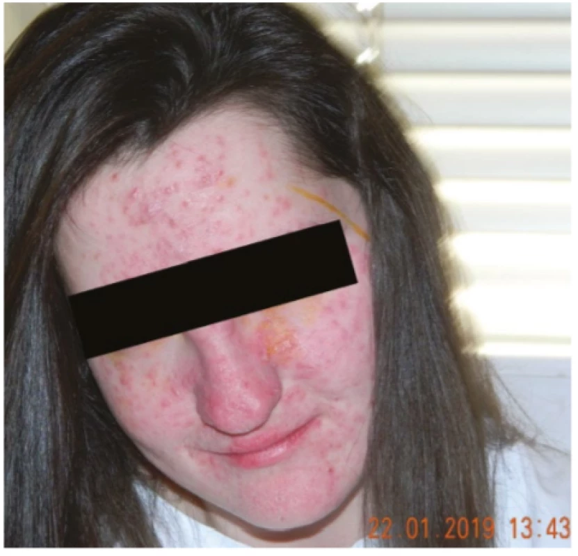 Face of patient from case report 1, papulopustules
with crust visible on face