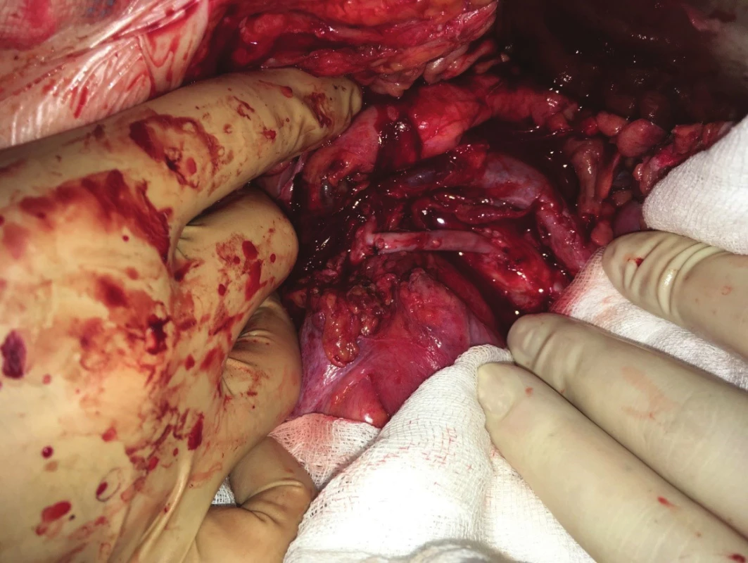 Retrográdní aorto-mezenterický žilní bypass<br>
Fig. 11: Retrograde aorto-mesenteric bypass (vein graft)