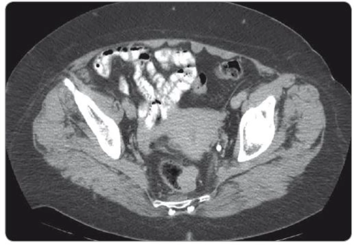 CT vyšetření – gastrointestinální stromální tumor rekta.