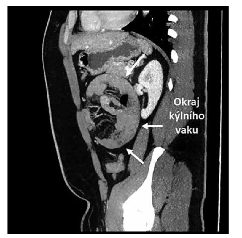 CT dutiny břišní, sagitální projekce<br>
Fig. 3: CT of abdominal cavity, sagittal projection