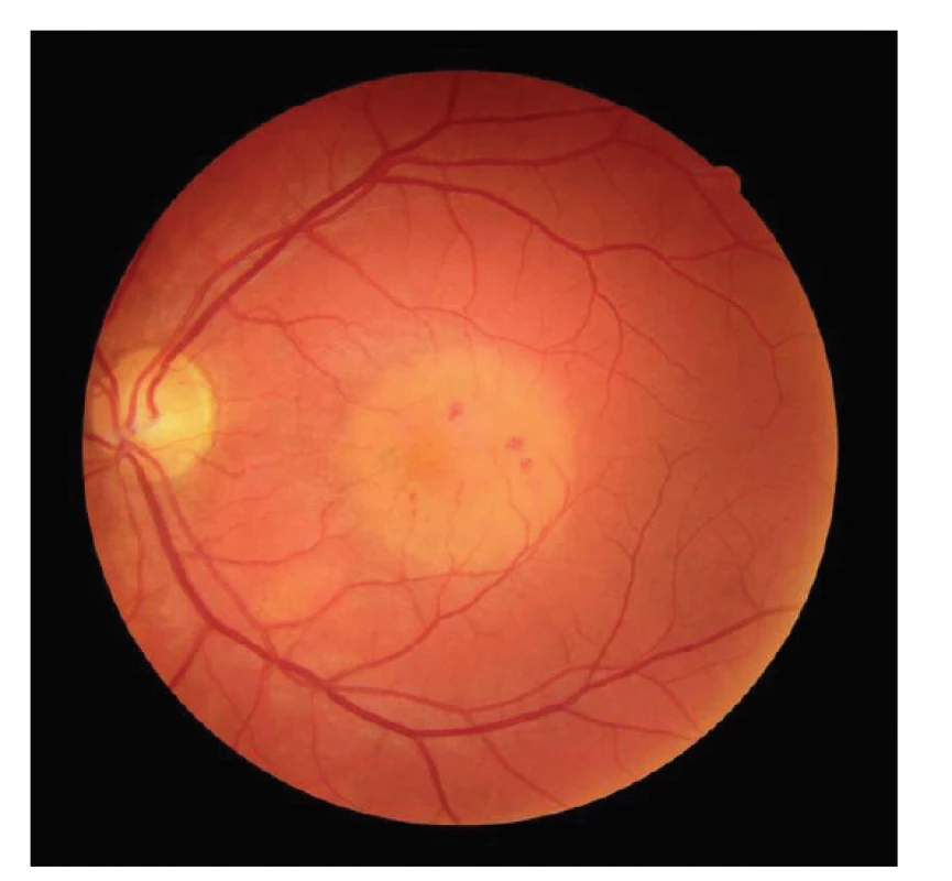 Snímek očního pozadí levého oka pacienta s chorioretinitidou