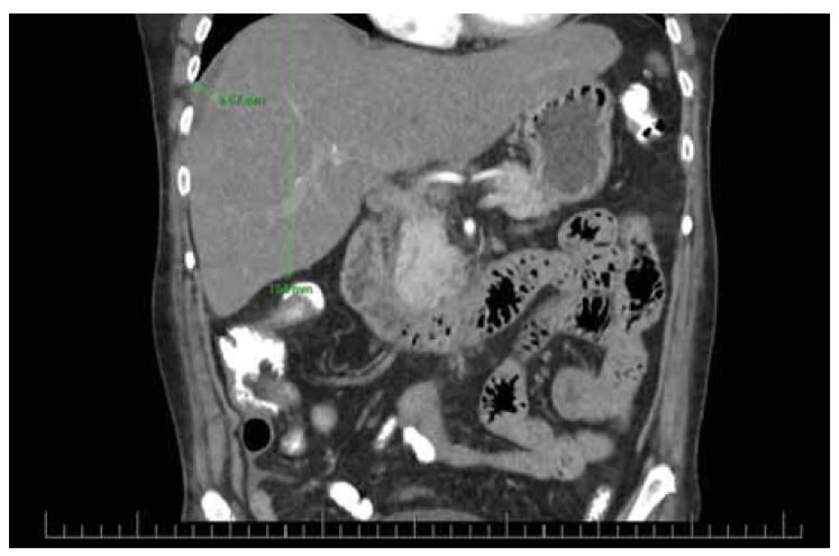 CT nález steatózy heparu s hepatomegáliou a ascitom.<br>
Fig. 4. CT finding of liver steatosis with hepatomegaly and ascites.