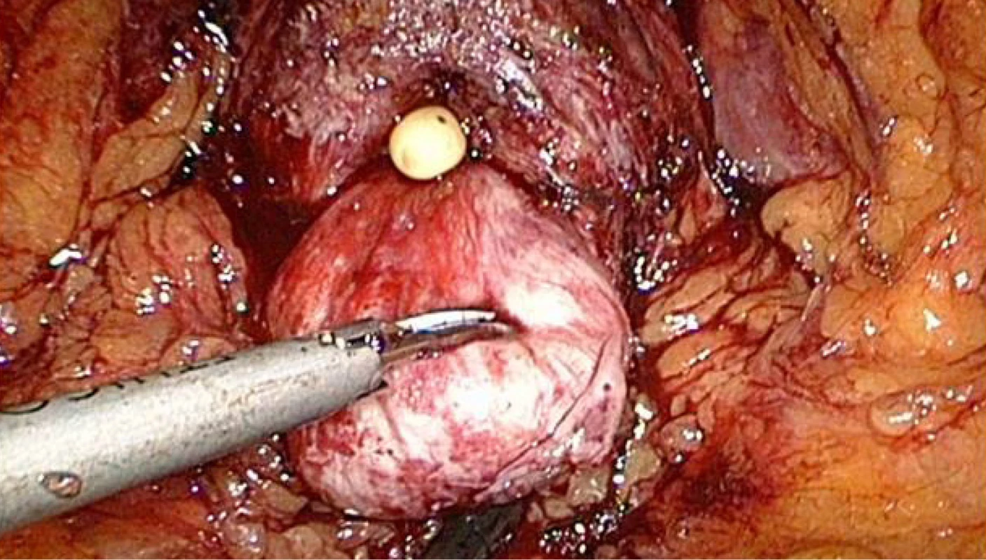 Prostata s velkým středním lalokem<br>
Fig. 4. Prostate with the large median lobe