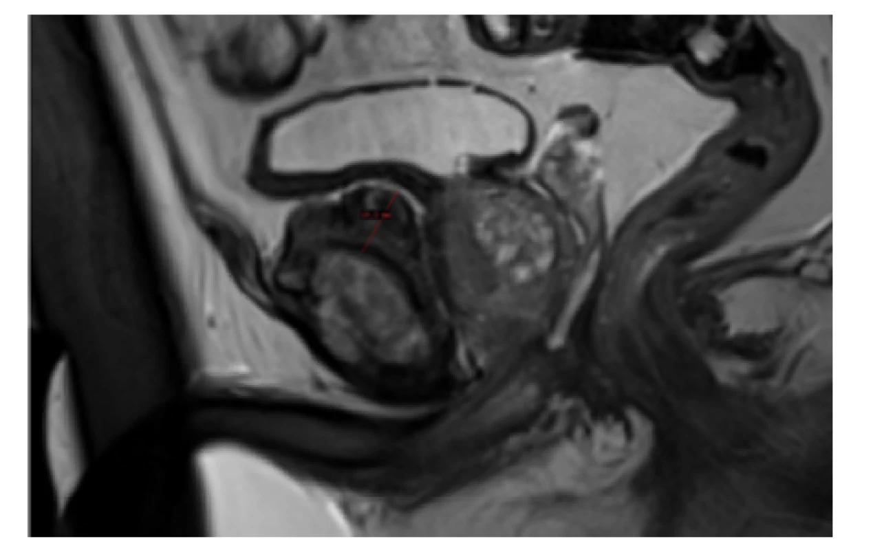 MRI, T2 vážení, sagitální řez oblastí pubické symfýzy;
měřítkem označena masivní protuberance šíře až 1,9 cm<br>
Fig. 1. MRI, T2, sagittal view through pubic symphysis;
massive pubic protuberance marked with gauge, width
up to 1.9 cm