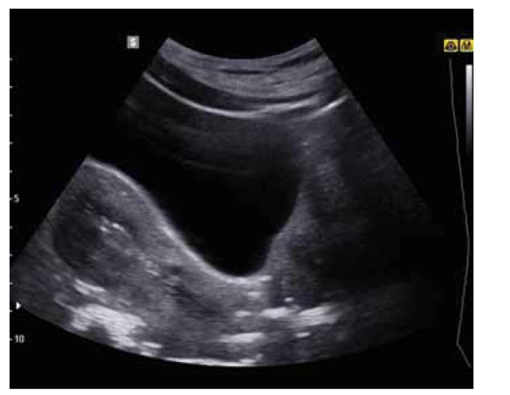 Ultrazvukové zobrazení aplikace antiadhezivního
gelu s patrnou separací stěn dutiny děložní.<br>
Fig. 2. Ultrasound imaging of the application of antiadhesive
gel with visualization of the separation of uterine walls.