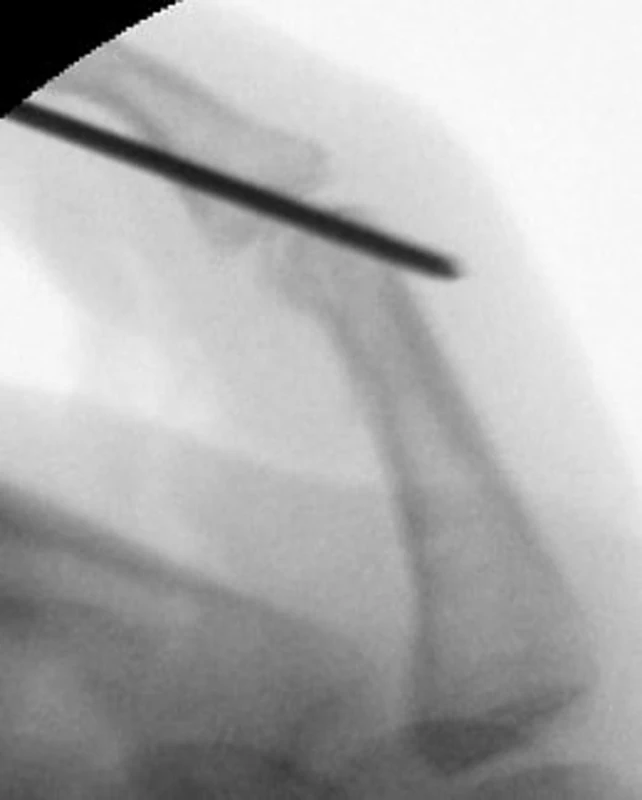 Peroperační snímek po provedení artroplastiky volární ploténkou a transfixaci PIP