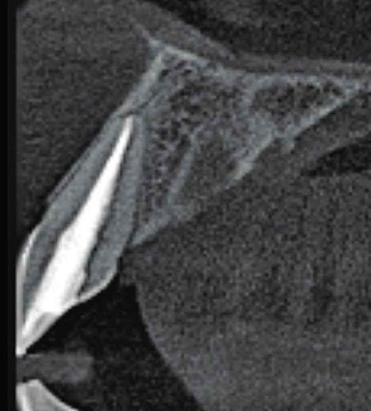 Axiální řez CBCT
snímku v místě zubu 11.
Je viditelné optimální
endodontické ošetření a
není přítomno periapikální
projasnění