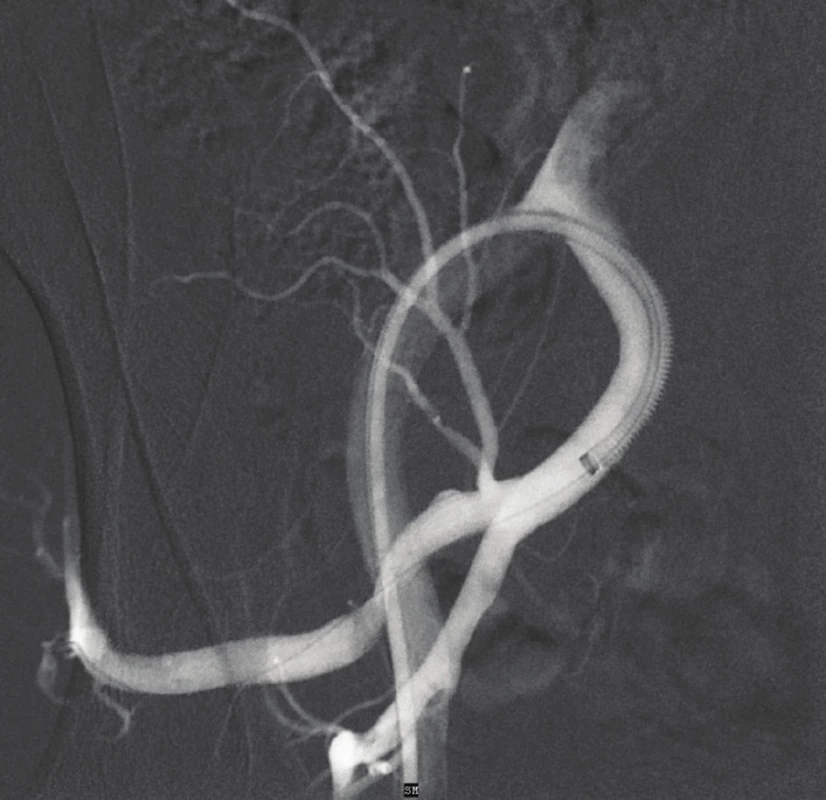 DSA – výsledek po zavedení stentgraftu (plnění
vaku aneuryzmatu není patrné)<br>
Fig. 3: DSA – outcome after the implantation of the stentgraft
(no leak of the contrast in aneurysm sac)