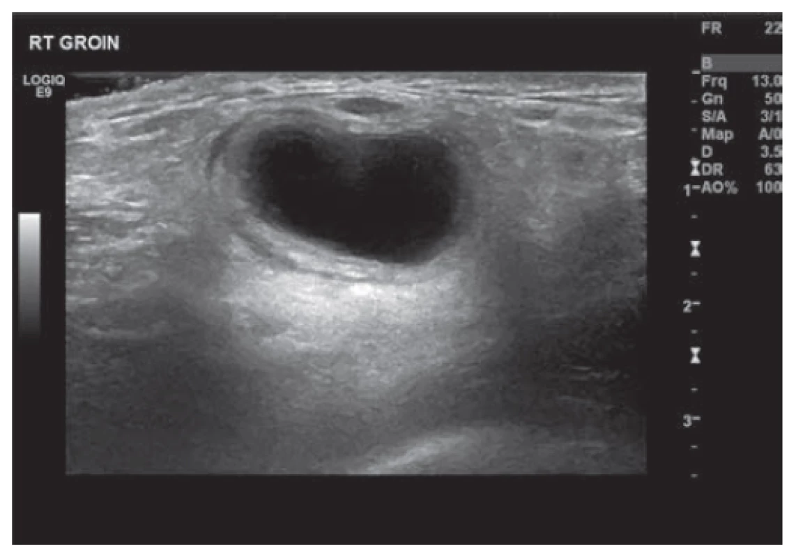 Ultrazvuk pravé kyčle zobrazující cystu<br>
Fig. 1: US right groin showing cyst