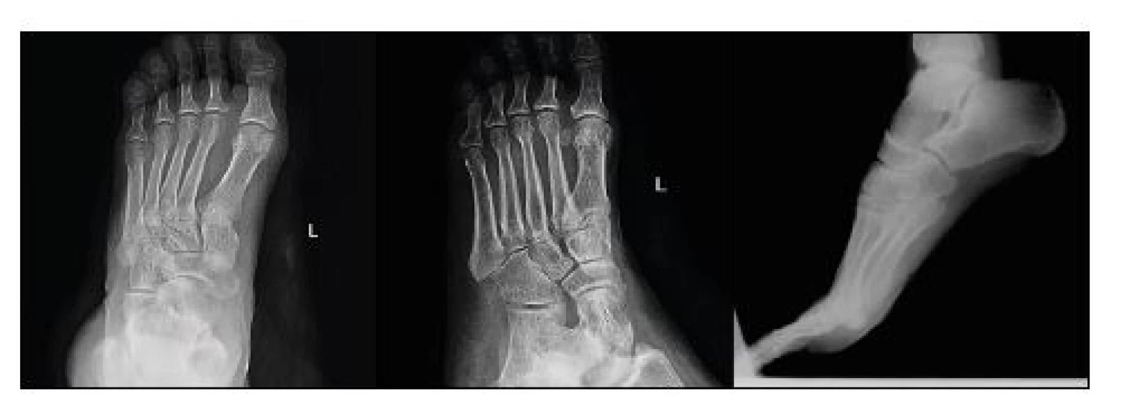 a, b, c: Foot radiograph – AP, oblique and lateral projection