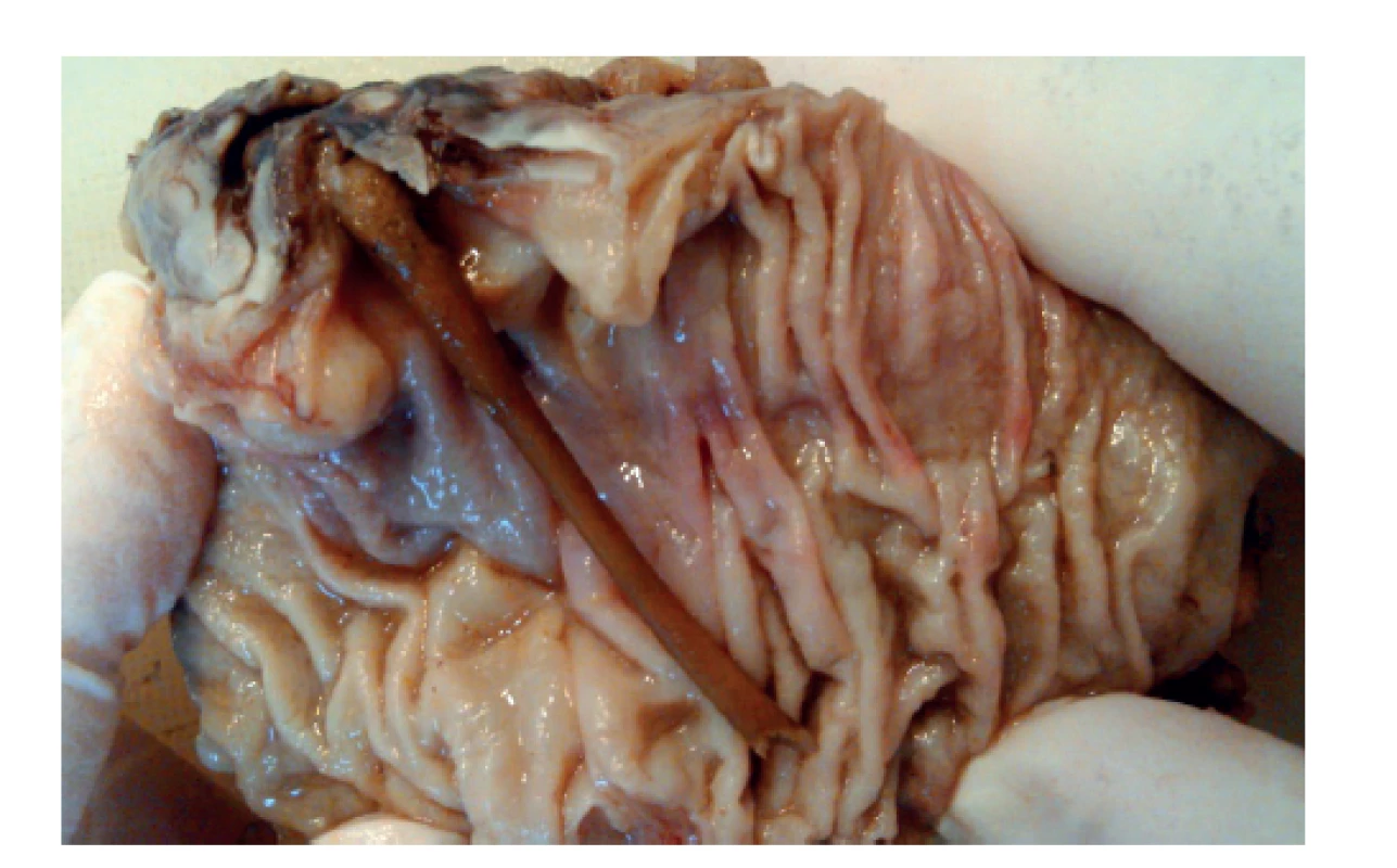 Resekát sestupného tračníku s kostí perforovaným
divertiklem<br>
Fig. 4: The specimen of the descending colon with perforated
diverticulum by bone