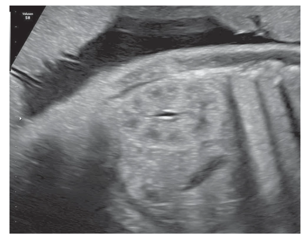 Fyziologický obraz fetálnej obličky v 31. týždni tehotnosti (foto autori).<br>
Fig. 1. Physiological picture of the fetal kidney in the 31st week of pregnancy
(photo by the authors).