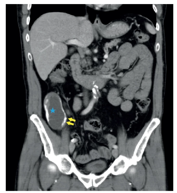 CT obraz mukokély apendixu – koronální rovina<br>
CT břicha s podáním kontrastní látky intravenózně, porto-
-venózní fáze, stejný pacient. V oblasti céka je patrný tubulární
útvar s hypodenzním obsahem (modrá hvězda). Jeho stěna
je nepravidelně kalcifikovaná (žluté šipky). Klinika radiologie
a nukleární medicíny FN Brno a LF MU.<br>
Fig. 4: CT scan of appendiceal mucocele – coronal plane<br>
CT of the abdomen with intravenous contrast, porto-venous
phase, the same patient. A tubular formation with hypodense
content is present in the area of the cecum (blue star). Its wall
is irregularly calcified (yellow arrows). Department of Radiology
and Nuclear Medicine, University Hospital Brno, Faculty
of Medicine, Masaryk University.