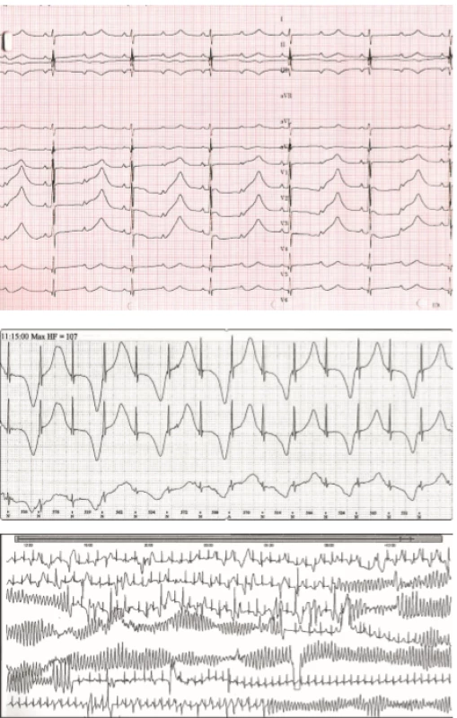 Syndrom dlouhého QT intervalu. 2A. Extrémně vyjádřený LQT syndrom u symptomatického novorozence. QTc 725 ms, funkční AV blok  II. stupně s převodem 2:1. P vlny jsou označeny šipkami. 2B. Alternující T vlny typické pro těžký fenotyp LQT syndromu. 2C. Komorová tachykardie torsades de pointes s typickou měnlivou polaritou QRS komplexů vedoucí k synkopě.