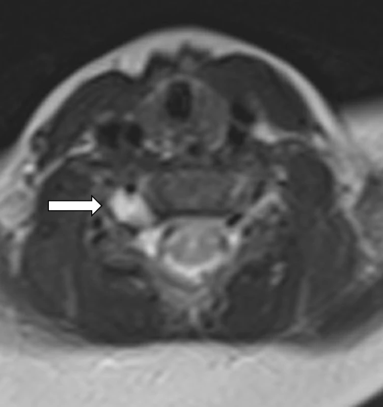 MRI – 2D T2 vážený obraz, axiální rovina v úrovni disku C5–6. Hypersignální pseudomeningocele foraminálně C5–6 vpravo.<br>
Fig. 6. MRI – 2D T2 weighted image, axial plane. Hyperintense pseudomeningocele at the level of right C5–6 neural foramen.