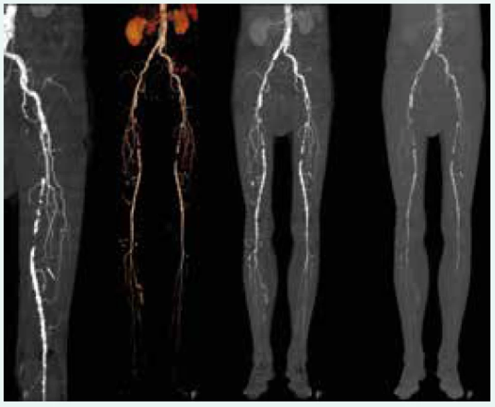 Aterosklerotické postižení tepen dolních
končetin při CT angiografii