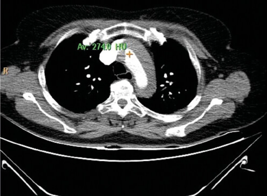 CT vyšetrenie, ascendentná aorta