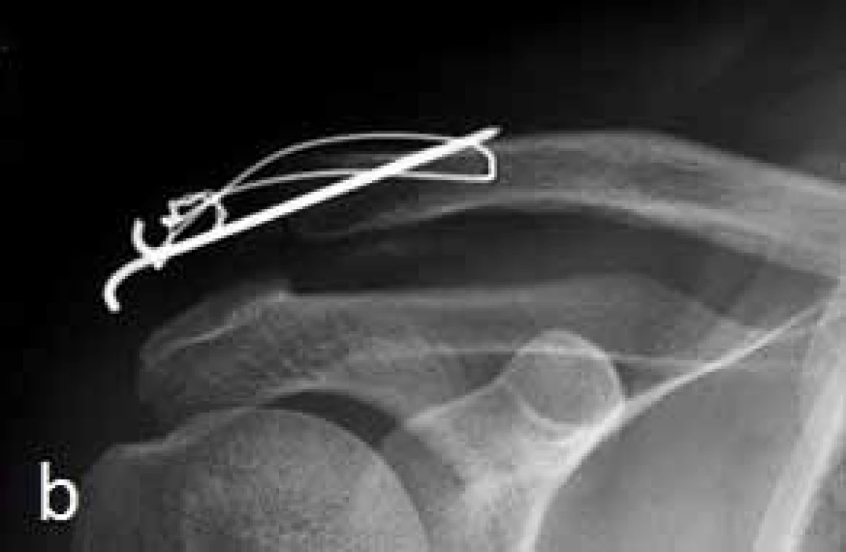 Man, aged 32, Rockwood type III AC dislocation after a fall in a run; a) Surgical finding after tension wire band stabilization, b)Condition at 1 month after surgery: band failure with AC articula tion separation 