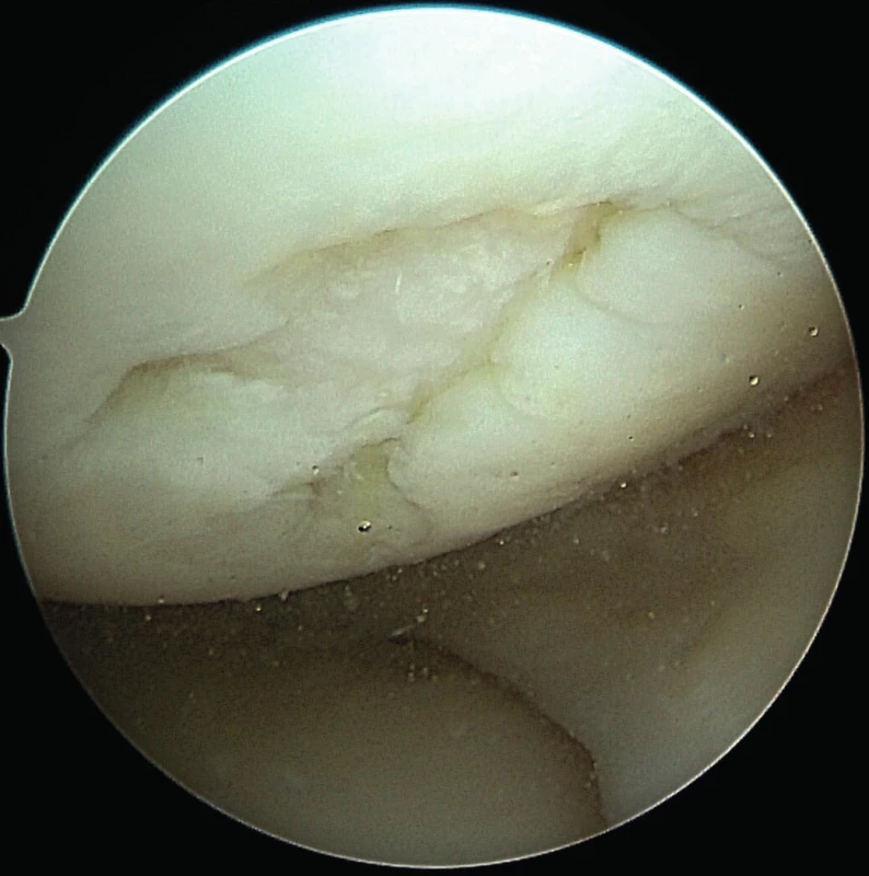 ASK nález chondrálního defektu mediálního kondylu
femuru pravého kolene