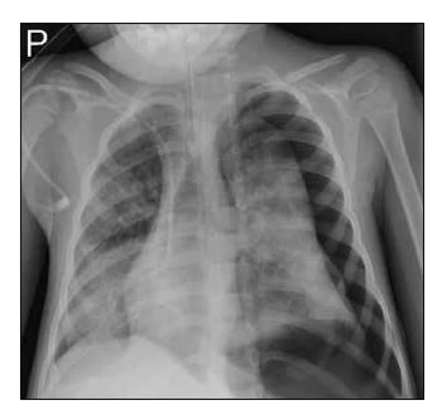 Rozsáhlý pneumotorax vlevo. Nález na
plicích u komplikovaného průběhu chřipky primárně
rizikového šestiletého pacienta. [Foto:
archiv autorky]