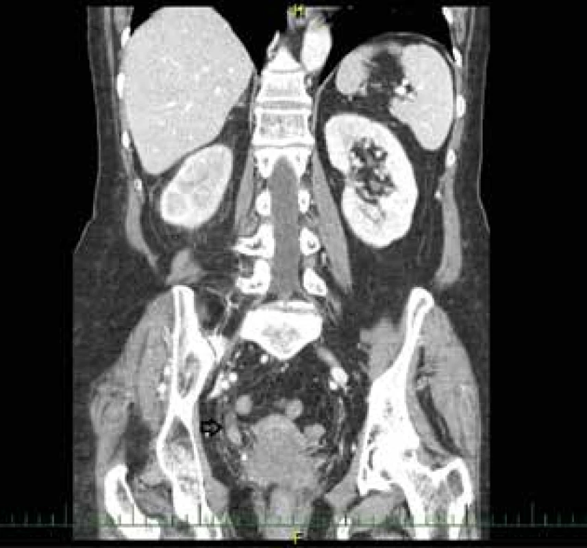 Uroteliální karcinom distálního močovodu, vpravo – CT<br>
Fig. 1: Urothelial carcinoma of the distal ureter, right – CT