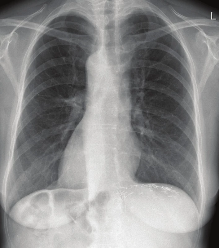 Postoperative chest X-ray showing dextrocardia
(thus complete situs inversus)<br>
Note the hemoclips at the resection plane of the liver under
the left portion of the diaphragm.