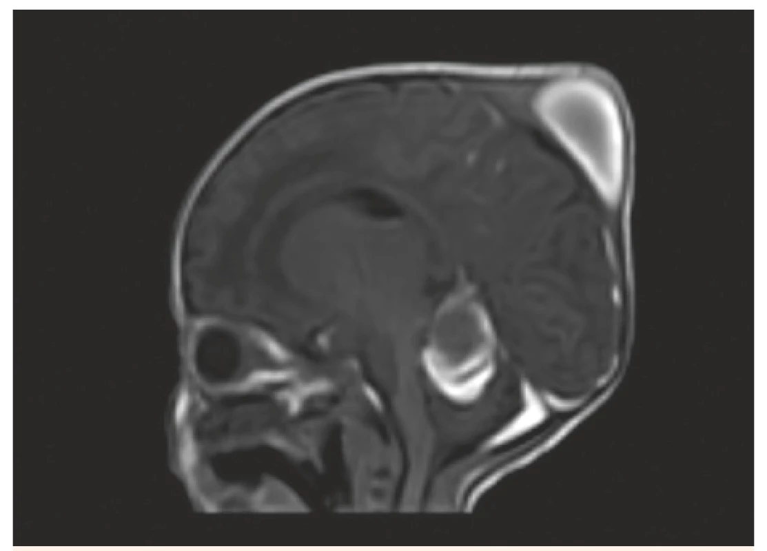MR vyšetření, sagitální řez – T1W FFE SENSE – stejný
pacient jako na obr. 3, 4, 5. Kefalhematom, subakutní
subdurální hematom podél tentoria a levé mozkové
i mozečkové hemisféry.<br>
Fig. 6. MR scan, sagittal view – T1W FFE SENSE – the same
patient as No. 3, 4, 5. Cephalhematoma, left sided
subacute subdural hematoma.