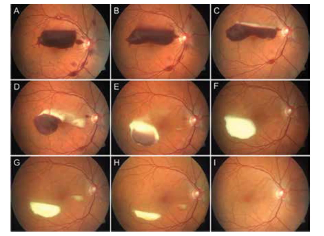 Subhyaloidní krvácení na pravém oku pacientky č. 1 na antikoagulační terapii
warfarinem (A), postupná resorpce krvácení při konzervativním postupu (B–I)
