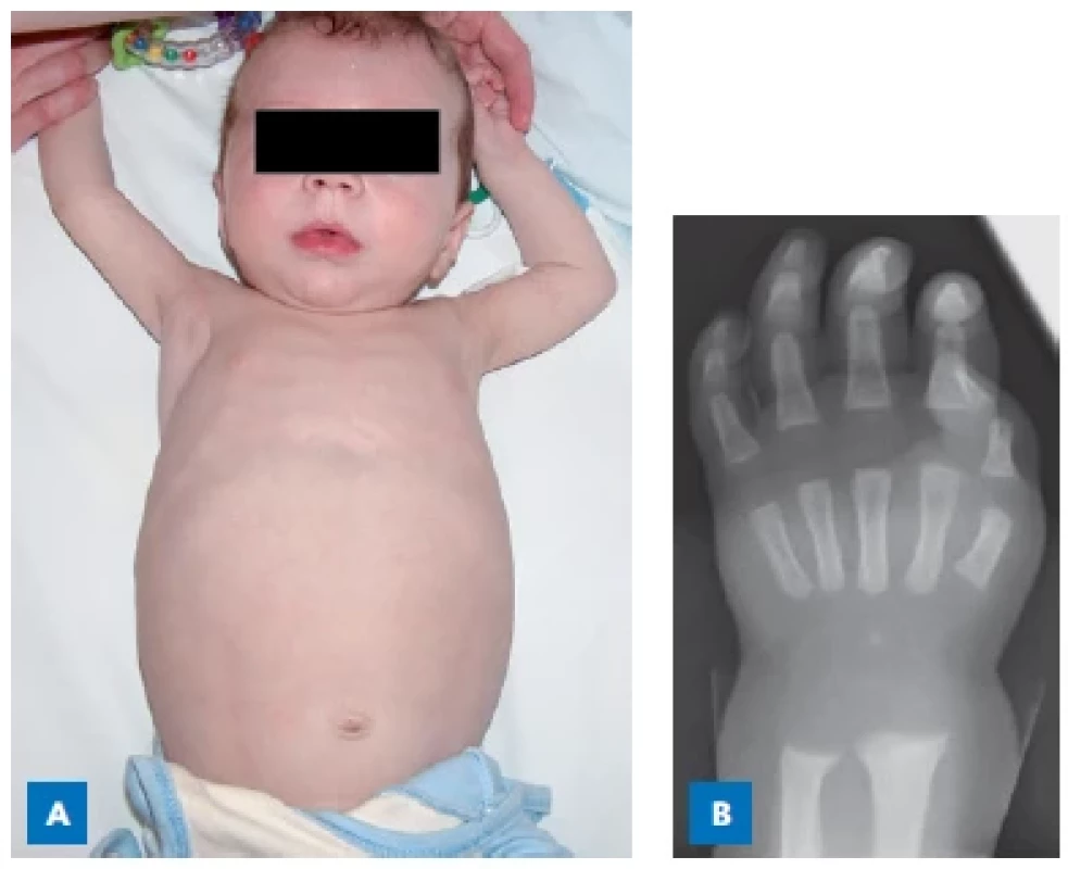 6měsíční chlapec s tyrosinemií typu 1. A – rachitický
růženec, objemné bříško s hepatomegalií. B – rtg známky floridní
křivice u stejného chlapce.