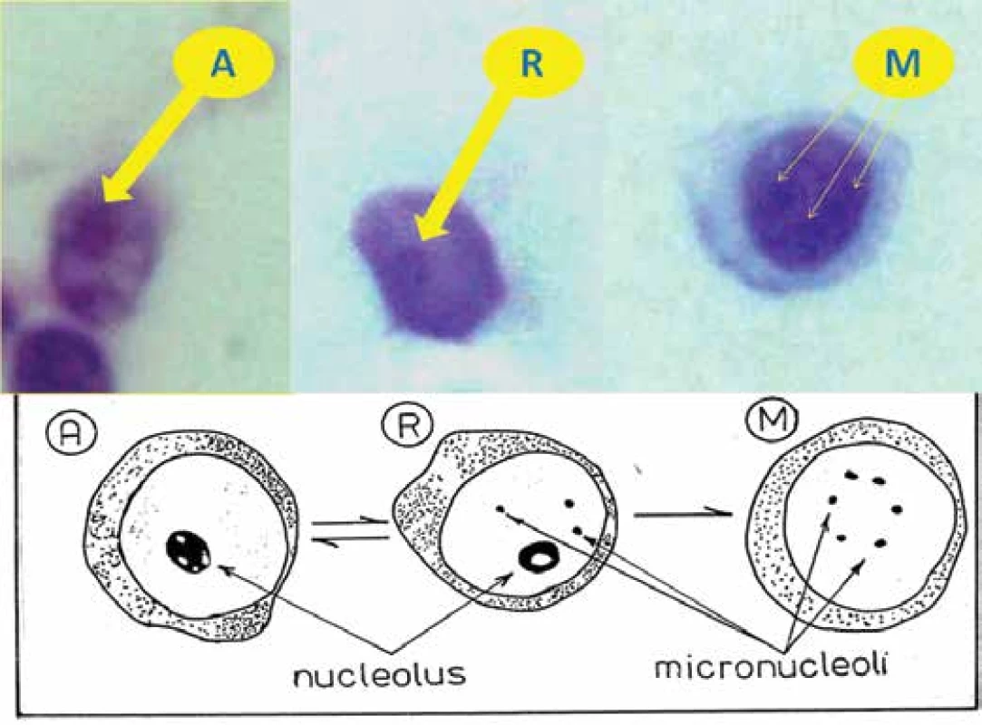 Schema of nucleolar test (NT) A – activated lymphocytes, R – lymphocytes with ring
nucleolus, M – lymphocytes only with micronucleoli, enlarged (1000x) from perspective of
illustration